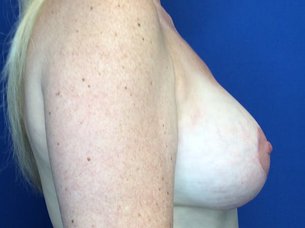 Breast Implant Removal and Replacement Before & After Gallery - Patient 140609768 - Image 4