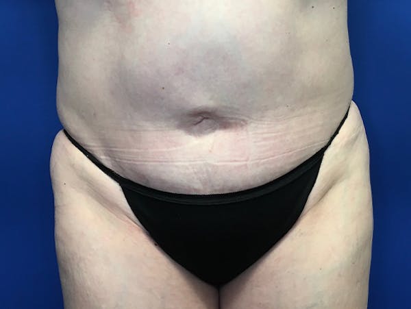 Liposuction Gallery - Patient 140609804 - Image 1