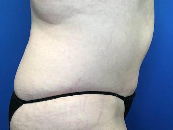 Liposuction Before & After Gallery - Patient 140609804 - Image 3