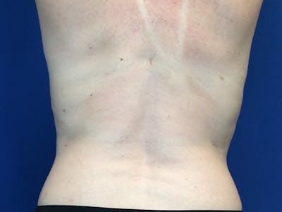 Liposuction Before & After Gallery - Patient 140609804 - Image 6
