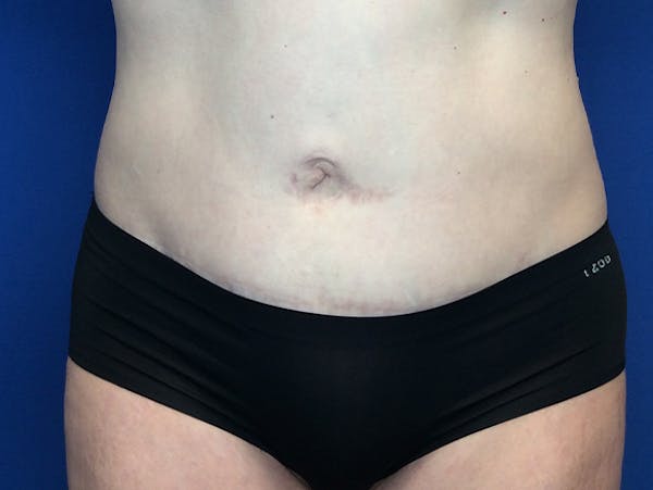 Liposuction Before & After Gallery - Patient 140609804 - Image 2