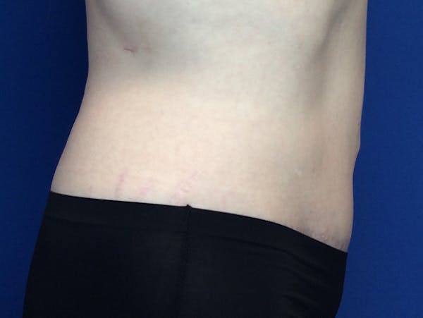 Liposuction Before & After Gallery - Patient 140609804 - Image 4