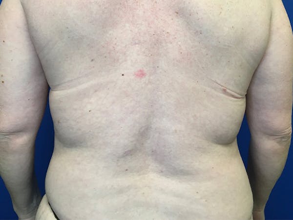 Liposuction Before & After Gallery - Patient 140609804 - Image 5