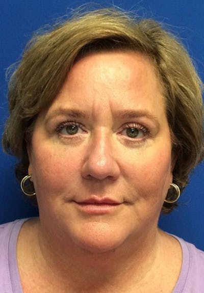 Blepharoplasty Before & After Gallery - Patient 141066194 - Image 2