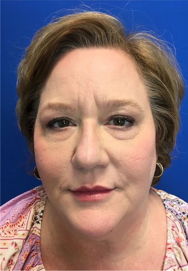 Blepharoplasty Before & After Gallery - Patient 141066194 - Image 1