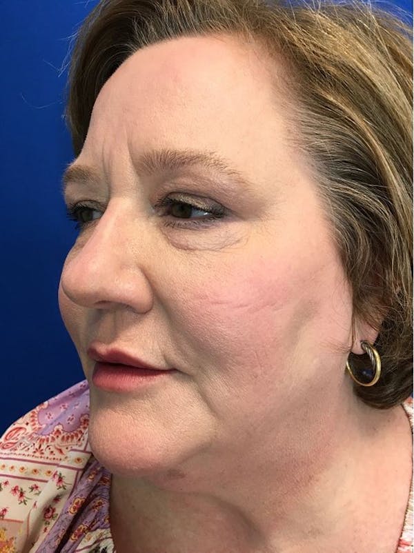 Blepharoplasty Before & After Gallery - Patient 141066194 - Image 3