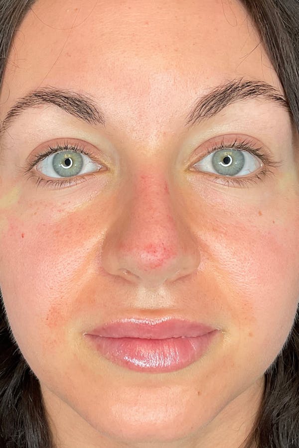 Rhinoplasty Before & After Gallery - Patient 142942821 - Image 4
