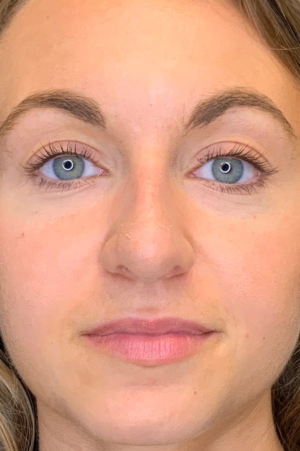 Rhinoplasty Before & After Gallery - Patient 142942821 - Image 1