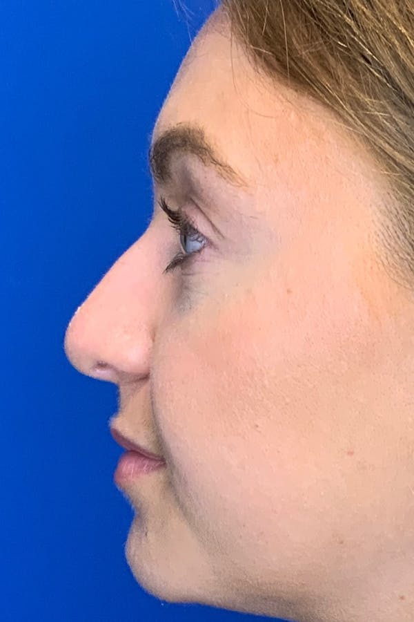 Rhinoplasty Before & After Gallery - Patient 142942821 - Image 3