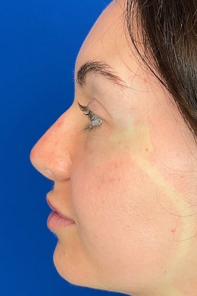 Rhinoplasty Before & After Gallery - Patient 142942821 - Image 4