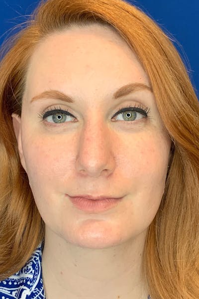 Rhinoplasty Before & After Gallery - Patient 142942873 - Image 1