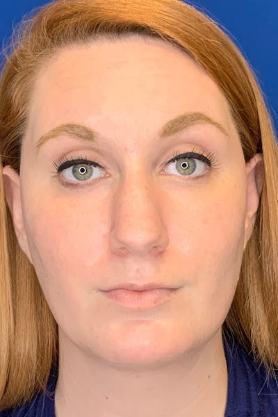 Rhinoplasty Before & After Gallery - Patient 142942873 - Image 2