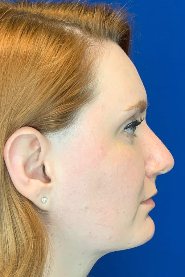 Rhinoplasty Before & After Gallery - Patient 142942873 - Image 3