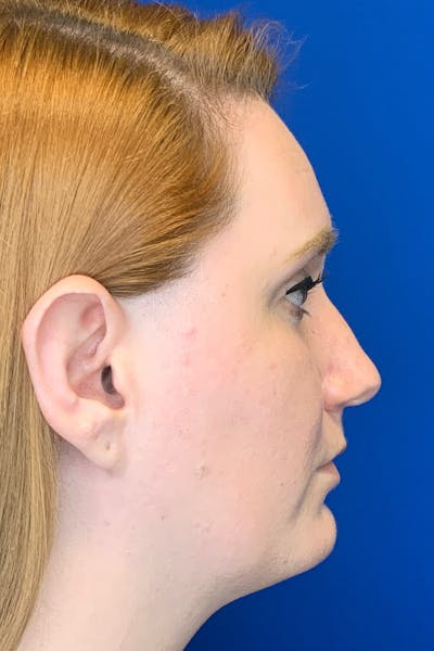 Rhinoplasty Before & After Gallery - Patient 142942873 - Image 4