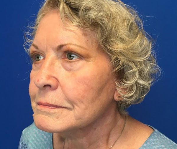 Neck Lift Before & After Gallery - Patient 142944370 - Image 4