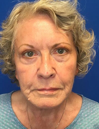 Face Lift Before & After Gallery - Patient 142944368 - Image 2