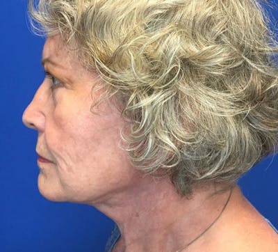 Blepharoplasty Before & After Gallery - Patient 142944360 - Image 6