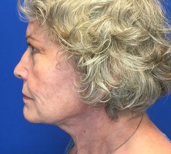 Neck Lift Before & After Gallery - Patient 142944370 - Image 6