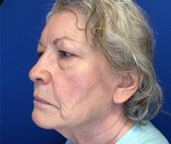 Face Lift Before & After Gallery - Patient 142944368 - Image 5