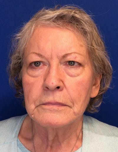 Face Lift Before & After Gallery - Patient 142944368 - Image 1