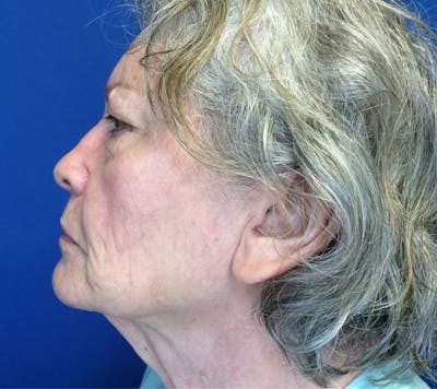 Face Lift Before & After Gallery - Patient 142944368 - Image 1