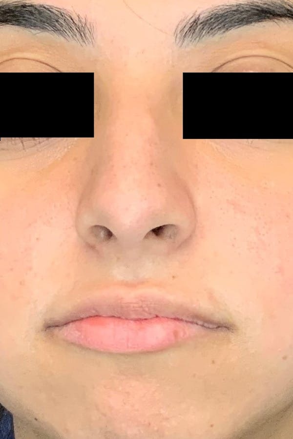 Rhinoplasty Before & After Gallery - Patient 142944676 - Image 1