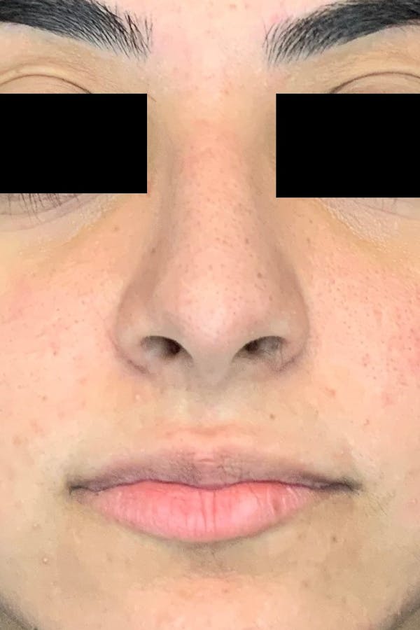 Rhinoplasty Before & After Gallery - Patient 142944676 - Image 2