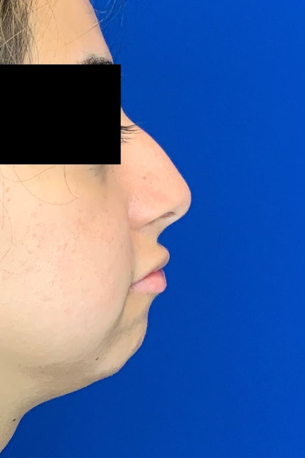 Rhinoplasty Before & After Gallery - Patient 142944676 - Image 3