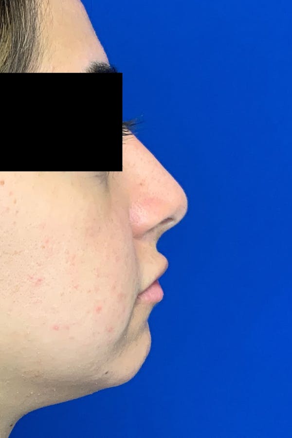 Rhinoplasty Before & After Gallery - Patient 142944676 - Image 4