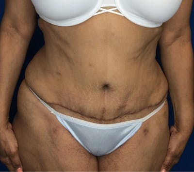 Tummy Tuck (Abdominoplasty) Before & After Gallery - Patient 142991787 - Image 2