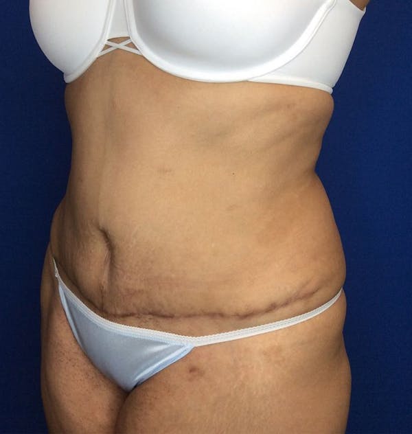 Tummy Tuck (Abdominoplasty) Before & After Gallery - Patient 142991787 - Image 4