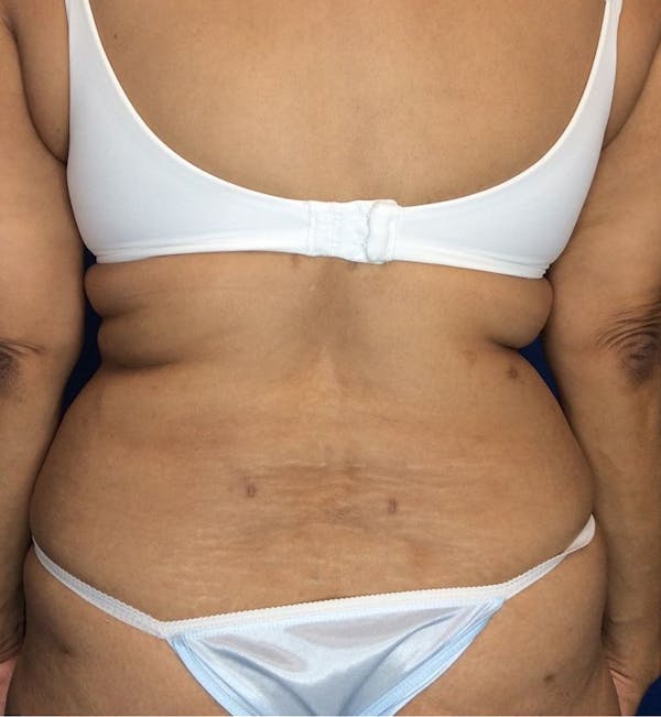 Liposuction Before & After Gallery - Patient 142991788 - Image 6