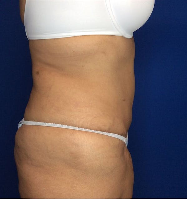 Liposuction Before & After Gallery - Patient 142991788 - Image 8