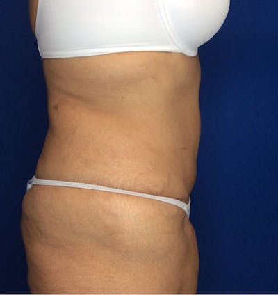 Liposuction Before & After Gallery - Patient 142991788 - Image 8