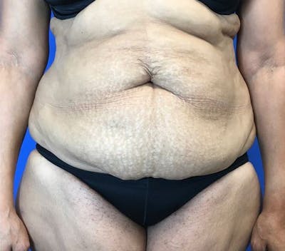 Liposuction Before & After Gallery - Patient 142991788 - Image 1