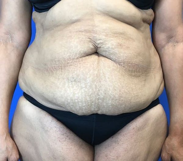 Tummy Tuck (Abdominoplasty) Before & After Gallery - Patient 142991787 - Image 1