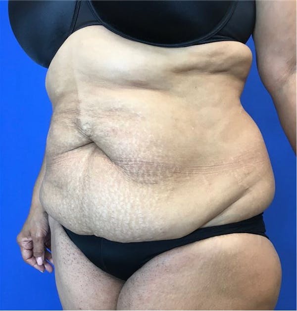 Liposuction Before & After Gallery - Patient 142991788 - Image 3