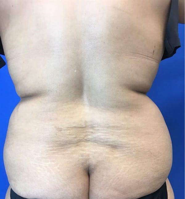 Liposuction Before & After Gallery - Patient 142991788 - Image 5