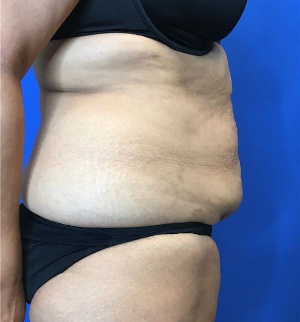 Liposuction Before & After Gallery - Patient 142991788 - Image 7