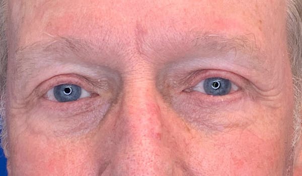 Blepharoplasty Before & After Gallery - Patient 143290737 - Image 2
