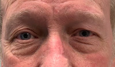 Blepharoplasty Before & After Gallery - Patient 143290737 - Image 1