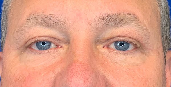 Blepharoplasty Before & After Gallery - Patient 143290738 - Image 2