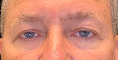 Blepharoplasty Before & After Gallery - Patient 143290738 - Image 1