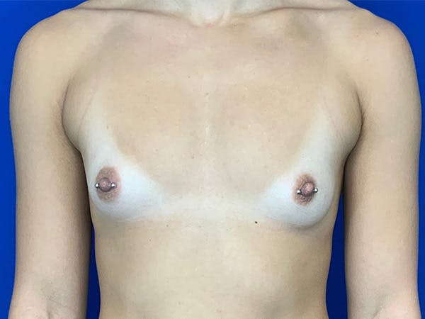 Breast Augmentation Before & After Gallery - Patient 143745275 - Image 1