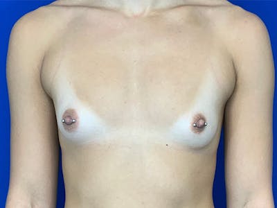 Breast Augmentation Before & After Gallery - Patient 143745275 - Image 1
