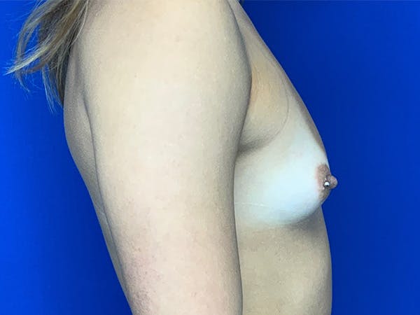 Breast Augmentation Before & After Gallery - Patient 143745275 - Image 3
