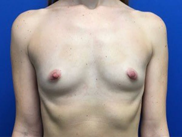 Breast Augmentation Before & After Gallery - Patient 143804680 - Image 1