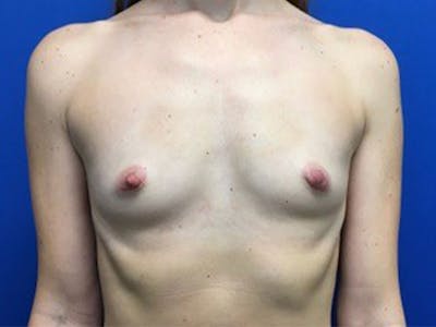 Breast Augmentation Before & After Gallery - Patient 143804680 - Image 1