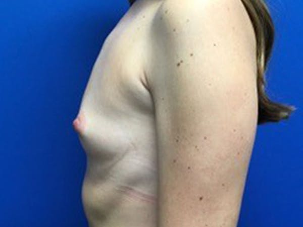 Breast Augmentation Before & After Gallery - Patient 143804680 - Image 3