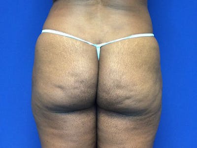 Brazilian Butt Lift Before & After Gallery - Patient 144197137 - Image 1
